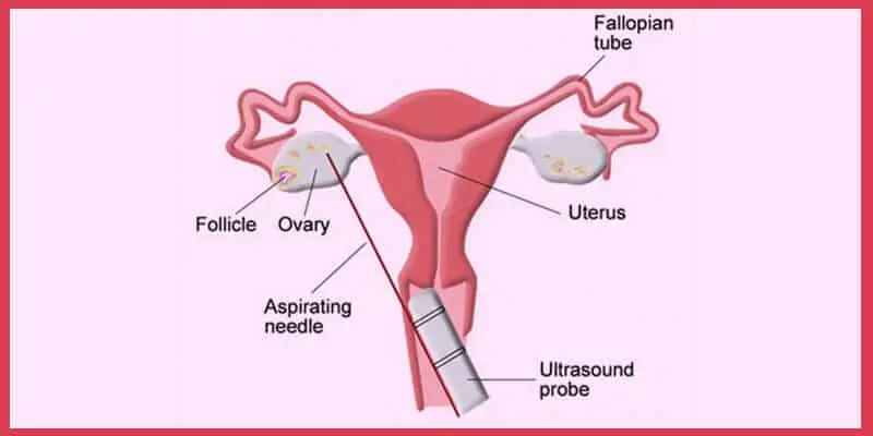 Ovulation Induction Cost in India