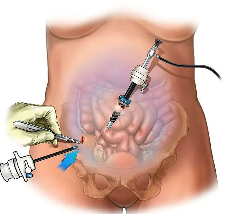 What is The Laparoscopy Cost in Delhi? 2 Laparoscopy Cost in Delhi